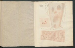 Erythema nodosum