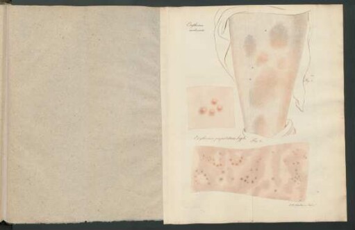 Erythema nodosum