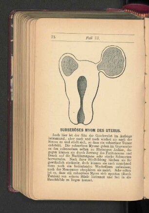 Subseröses Myom des Uterus.