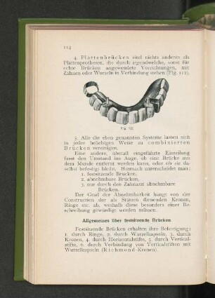 Allgemeines über festsitzende Brücken.