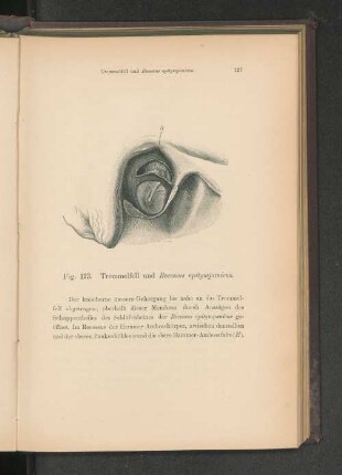 Fig. 123. Trommelfell und Recessus epitympanicus.