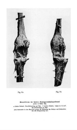 Fig. 8a - Fig. 8b Bruchform der hintern Kniegelenkskapselwand