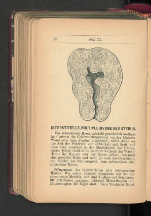 Interstitielle, multiple Myome des Uterus.