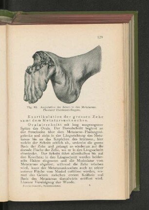 Fig. 83. Amputation der Zehen in den Metatarsen.