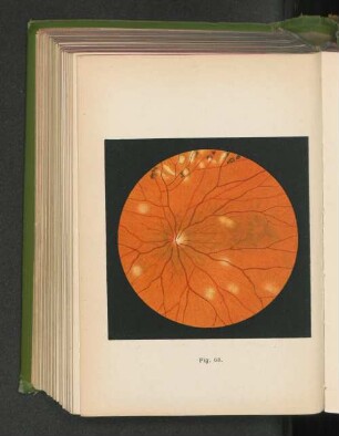 Fig. 68. Herdförmige, frische Aderhautentzündung - Chorioditis disseminata.