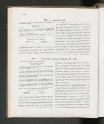Abb. 17 Embolisch-septische Infarkte der Milz
