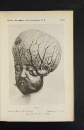 Tafel I. Roemer, Endotheliom der Dura mater.