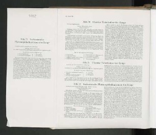 Abb. 73 Verhornendes Plattenepithelkarzionom der Zunge