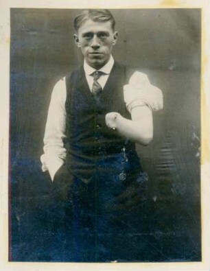 Foto eines Mannes mit amputierter linker Hand im Königlichen Reservelazarett in Singen