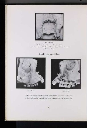 Figur Nr. 64 Oberkiefer, in welchem der Zwischenkiefer mit zwei rotierten Eckzähnen sich vom übrigen harten Gaumen wulstartig abhebt.