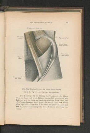 Fig. 519, Taschenbildung der Fossa iliaca sinistra.