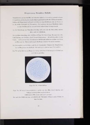 Blutgerinnung, Thrombise, Embolie