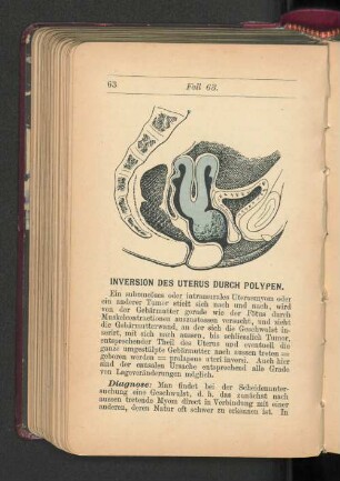 Inversion des Uterus durch Polypen.