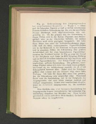 Fig. 40. Erkrankung des Augengrundes bei angeborener Syphilis - Typus I.