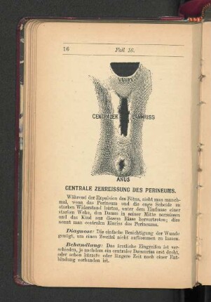 Centrale Zerreissung des Perineums.