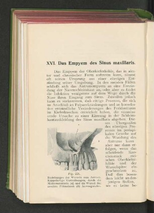 XVI. Das Empyem des Sinus maxillaris.