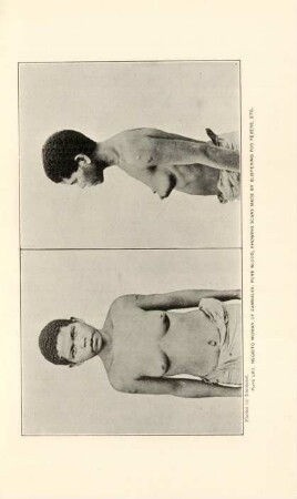 Plate LVII. Negrito woman of Zambales, pure blood, showing scares made by blistering for fevers, etc.