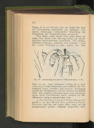 3. Dacryostenose, Sondierung.