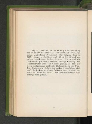Fig. 18. Starke Entzündung und Stauung im Sehnerv bei Orbital-Geschwulst.