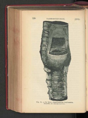 Fig. 54. - Im Ileum eingeklemmter Gallenstein.