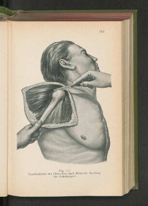 Fig. 117. Exartikulation des Oberarmes nach Esmarch; Spaltung der Gelenkkapsel.