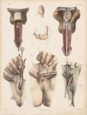 Verschiedene Operationen an der Harnröhre, der Prostata und der Harnblase