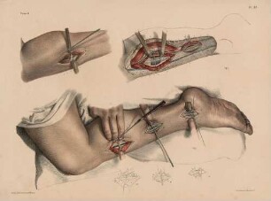 Ligatur der Arteria tibialis posterior