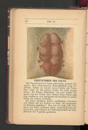 Vegetationen der Vulva.