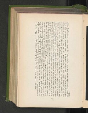 Fig. 69. Alte herdförmige Aderhautentzündung - Chorioditis disseminata.