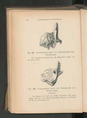 Fig. 146. Frontalschnitt durch den Warzenteil eines Neugeborenen.