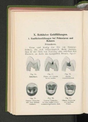 1. Kauflächenfüllungen bei Prämolaren und Molaren.