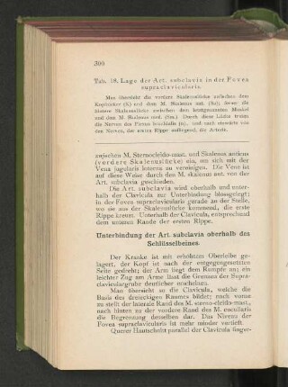 Unterbindung der Art. subclavia overhalb des Schlüsselbeines.
