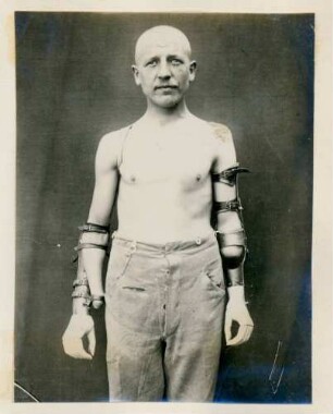 Foto eines Mannes mit amputierten Armen in Armprothesen im Kngl. Reservelazarett in Singen