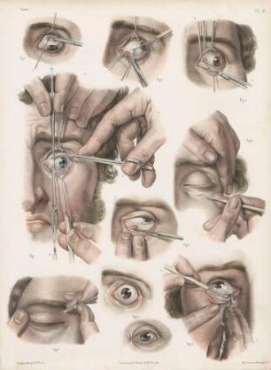 Operation schielender Augen
