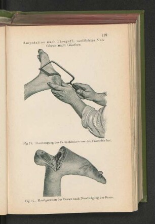 Fig. 76. Durchsägung des Fersenhöckers von der Fusssohle her.