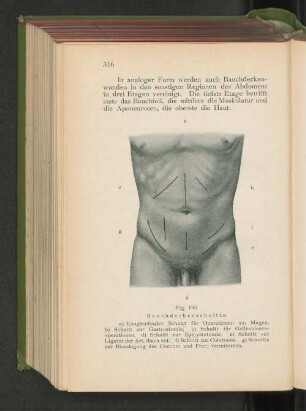 Fig. 190. Bauchdeckenschnitte.