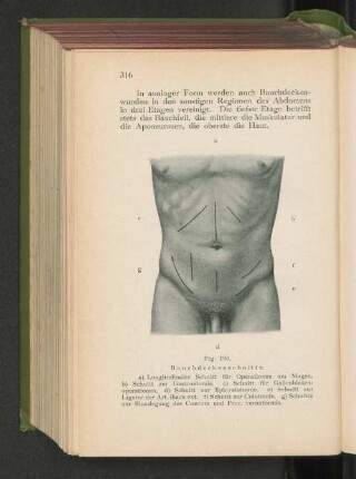 Fig. 190. Bauchdeckenschnitte.