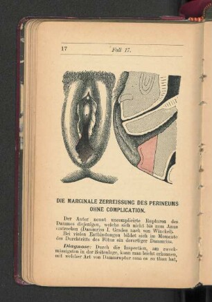 Die marginale Zerreissung des Perineums ohne Complication.