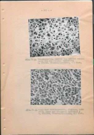 Abb. 20a: Hodgkinsarkom. Abb. 20b: Typisches Retothelsarkom.
