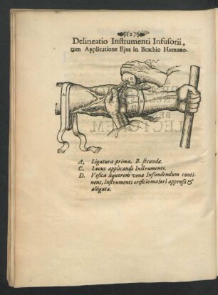 Delineatio Instrumenti Infusorii, cum Applicatione Ejus in Brachio Humano.