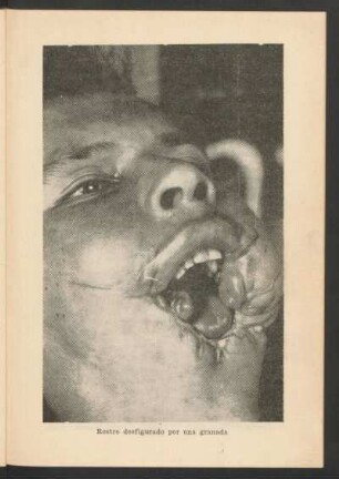 Rostro desfigurado por una granada - [Fotografía]
