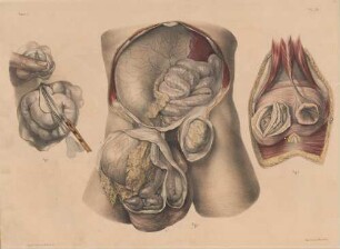 Die Anatomie von Hernien