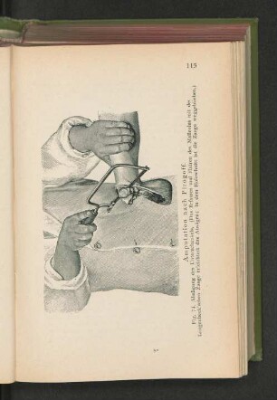 Fig. 74. Amputation nach Pirogoff. Absägung des Unterschenkels.