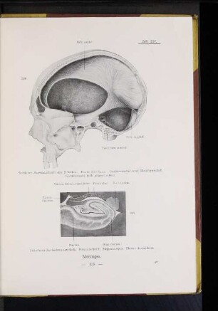 237 Unterhorn des Seitenventrikels. Frontalschnitt. Hippocampus. Plexus chorioideus.