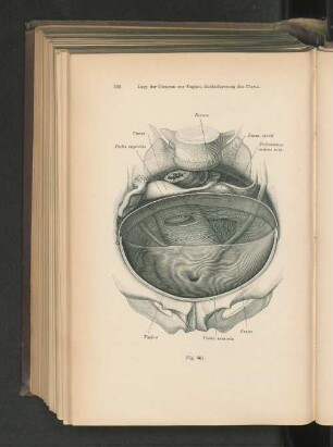 Fig. 461. Lage der Ureteren zur Vagina, Rechtslagerung des Uterus.