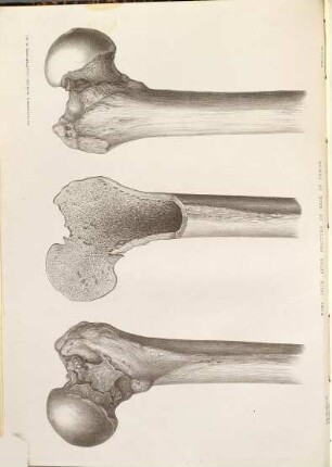 Illustrations of Clinical Surgery : consisting of plates, photographs, woodcuts diagrams etc. illustrating surgical diseases, symptoms and other methods of treatment with descriptive letterpress, 2