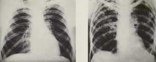 Rüntgenbild Lunge : Röntgenbilder links einer gesunden (36 Jahre) und rechts einer cavernös-tuberkulösen (34 Jahre) Lunge