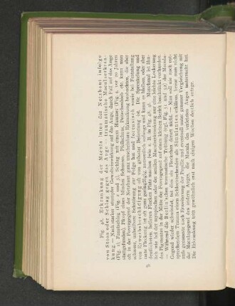 Fig. 48. Erkrankung der Macula lutea der Netzhaut infolge von Stoss oder Schlag gegen das Auge.