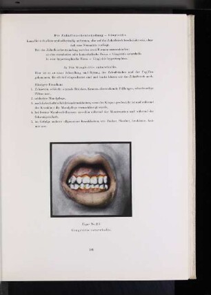 Figur Nr. 201 Gingivitis catarrhalis.