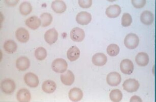 Hamburg. Rote Blutkörperchen, die von Malaria-Parasiten befallen sind